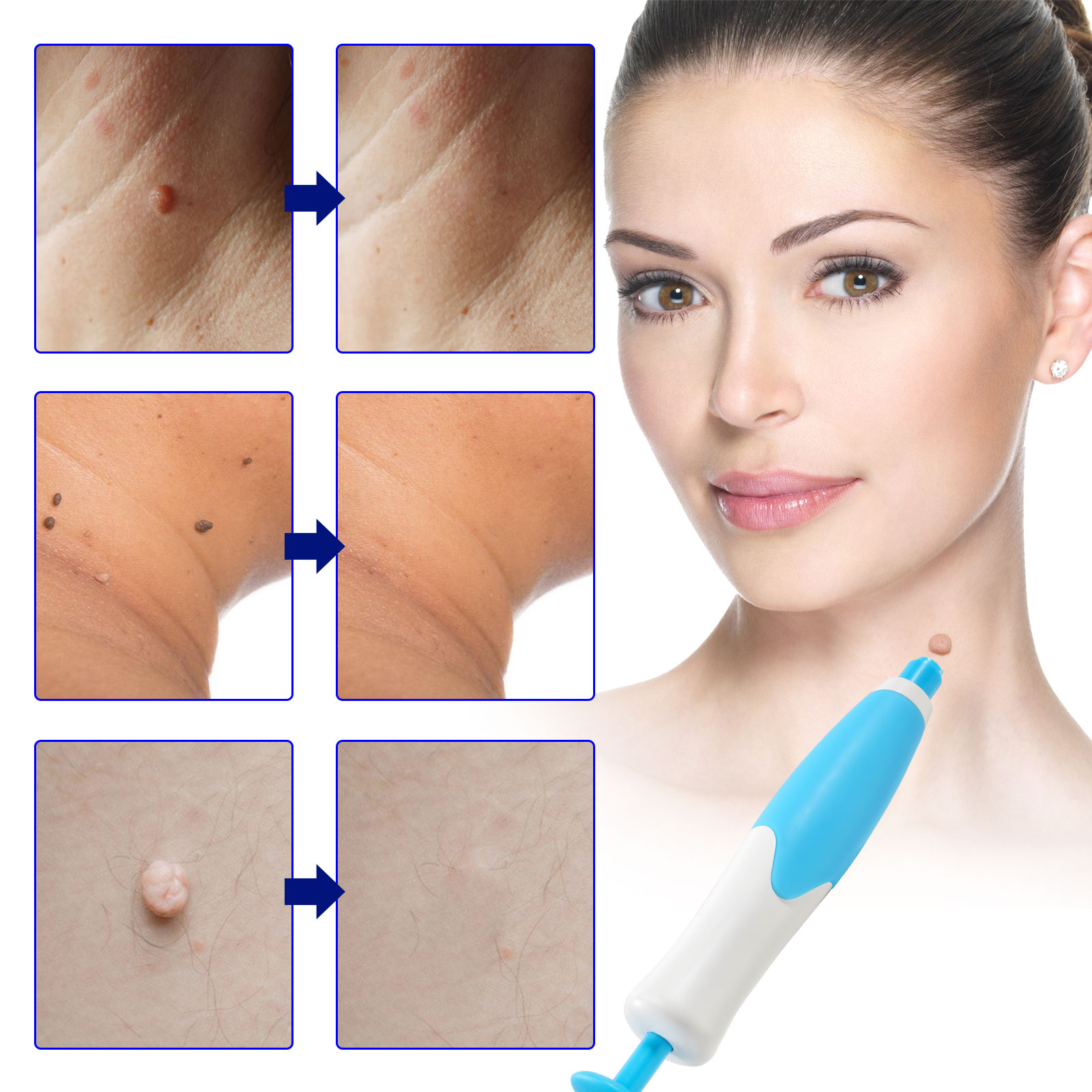 Skin Tag Removal Kit - Image 3