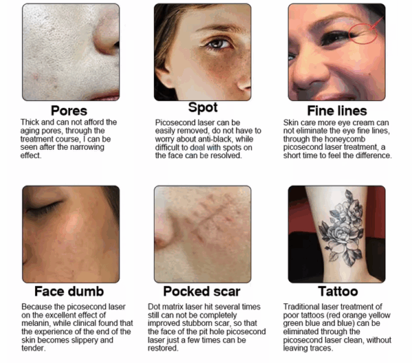 ULive Tattoo Remover And Carbon Peel Laser Machine - Image 5